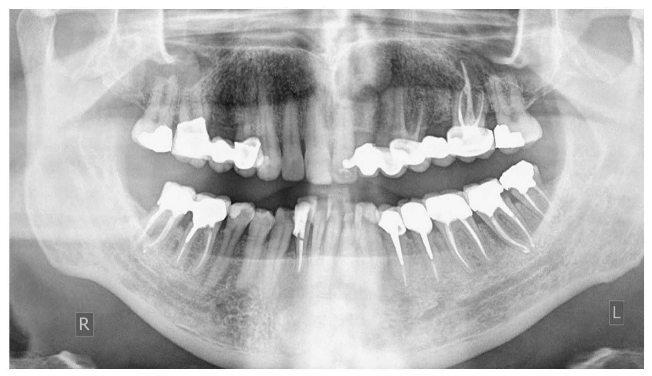 Tooth Hemisection Root Resective Procedures: A Case Series of Tooth Hemisection and ...