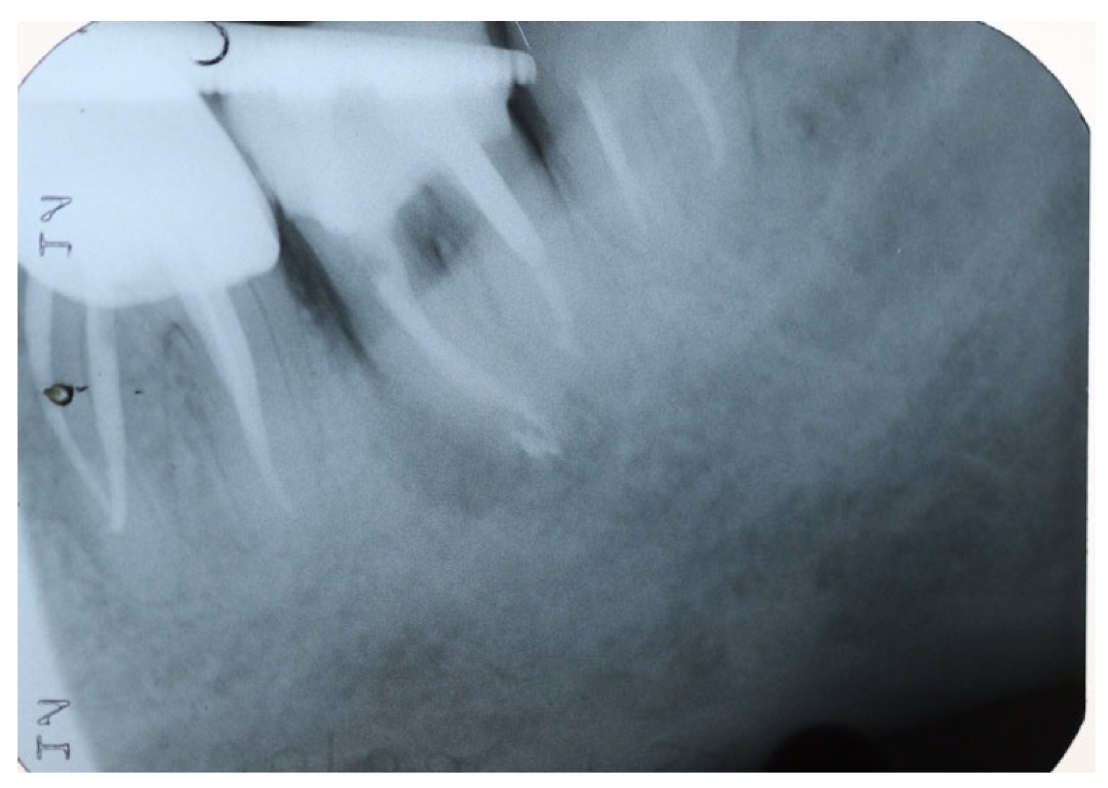 Tooth Hemisection Root Resective Procedures: A Case Series of Tooth Hemisection and ...