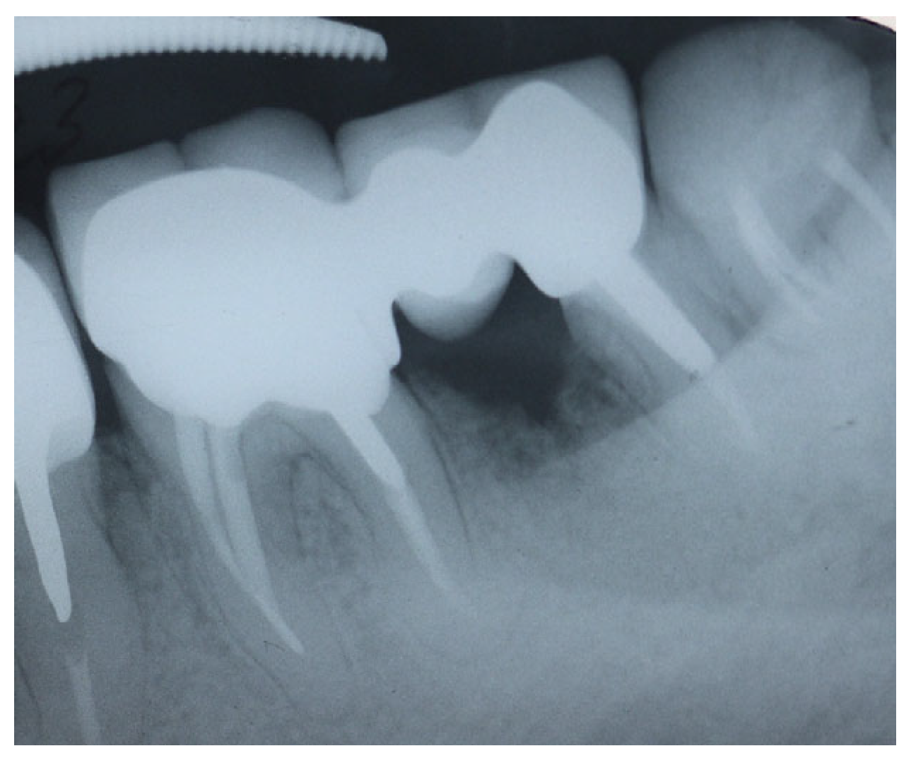 Tooth Hemisection Root Resective Procedures: A Case Series of Tooth Hemisection and ...