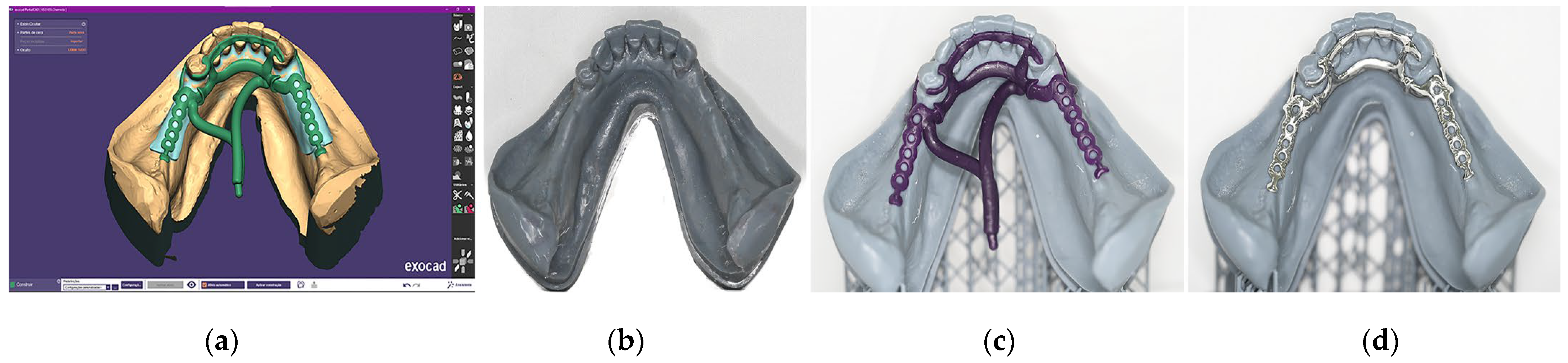 Hybrid Digital Workflow for Accurate Distal Extension Reproduction in ...