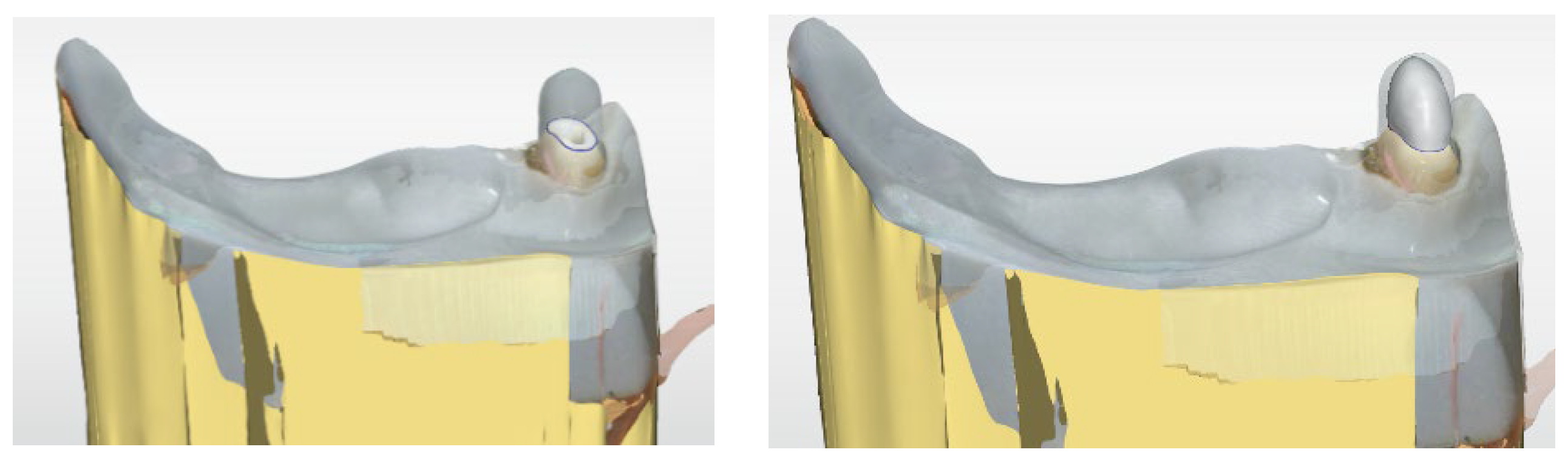 Core Range Retained Post and Core for Telescopic Crown-Retained Dentures—An In Vitro ...
