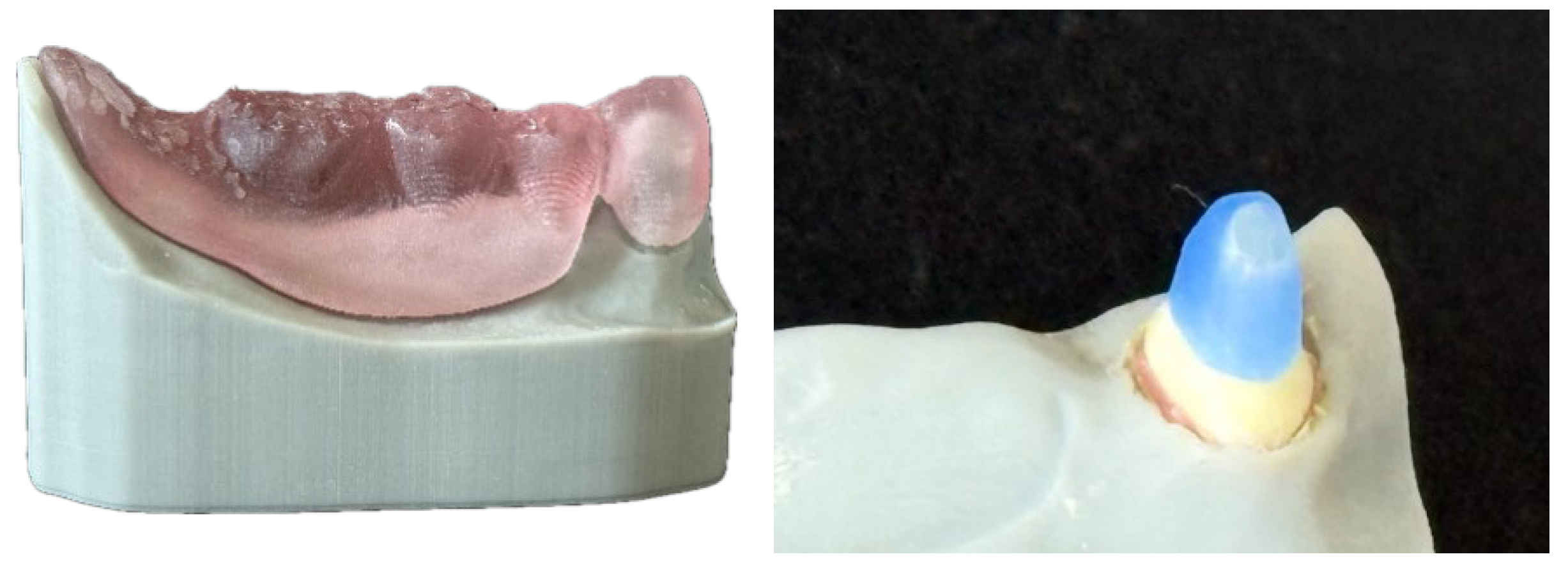 Core Range Retained Post and Core for Telescopic Crown-Retained Dentures—An In Vitro ...