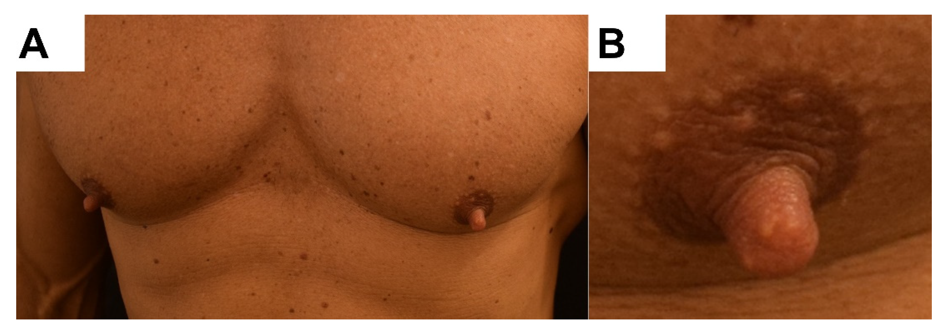 Dermatopathology Free Full Text Bilateral Nipple Enlargement