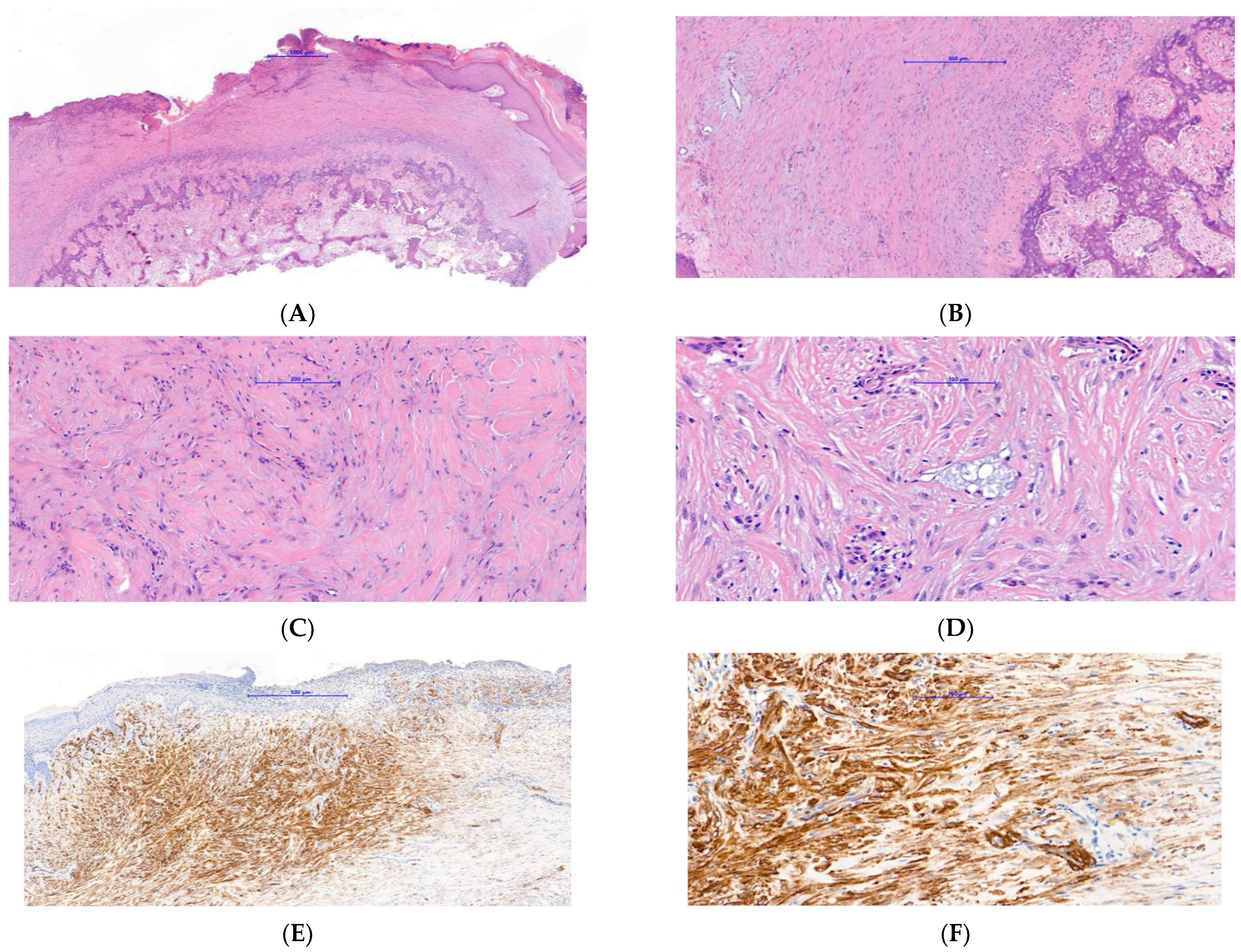Melanonychia striata secondary to pigmented nail matrix fibroma simulating  nodular melanoma | Semantic Scholar