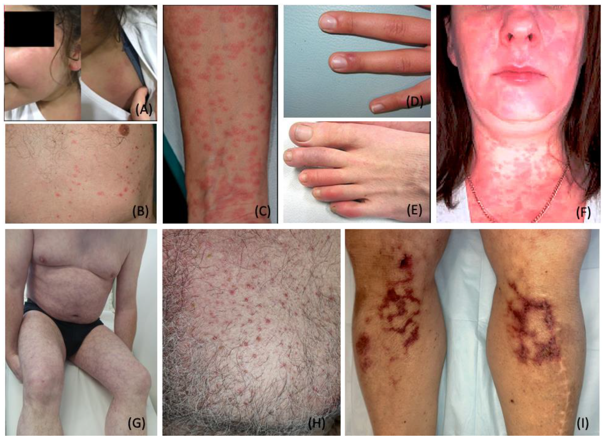 Erythroderma secondary to toxic shock syndrome.