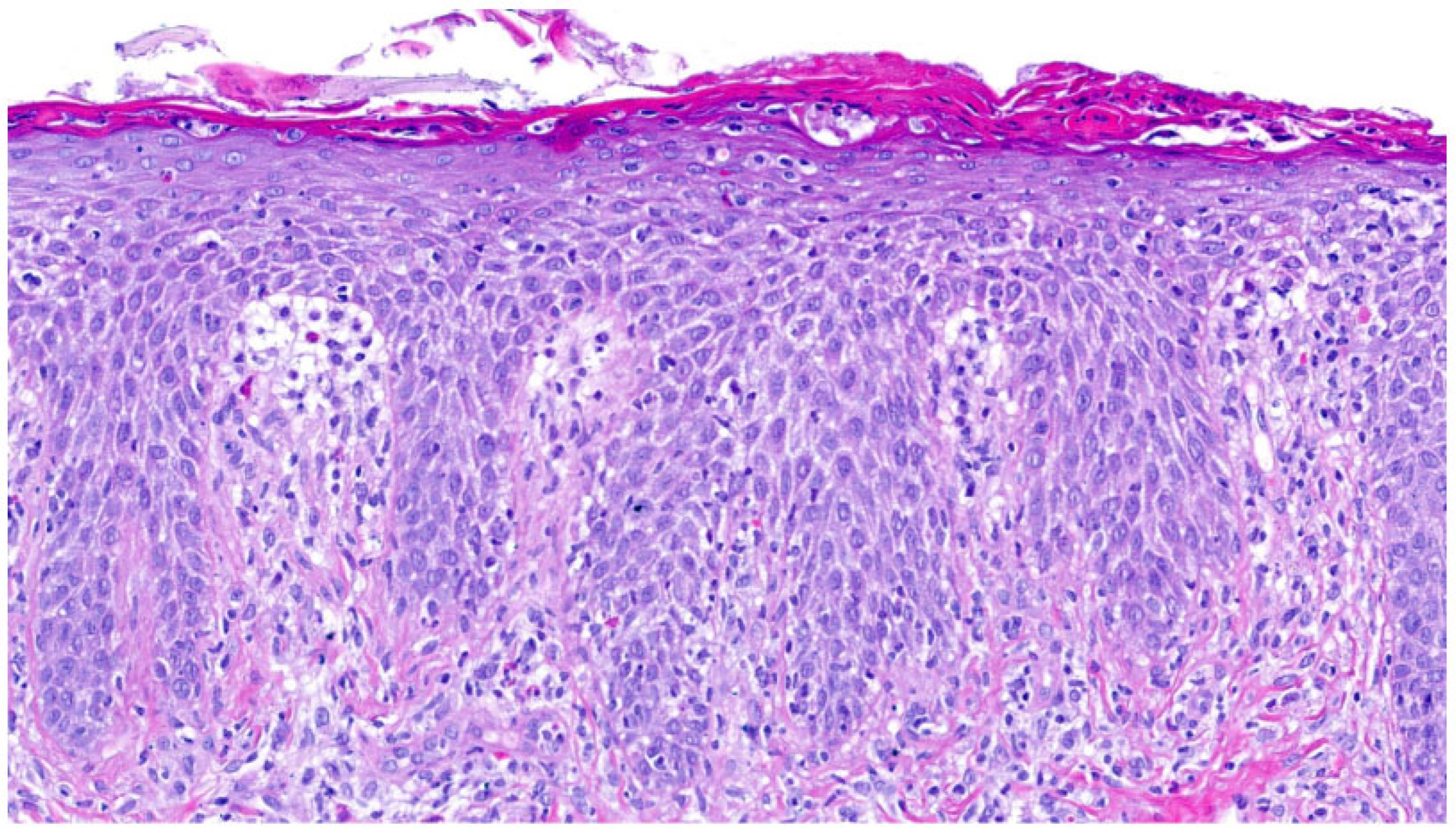 Pathological Test Pattern Defining Histological Patterns in Inherited Ichthyoses: Toward a ...
