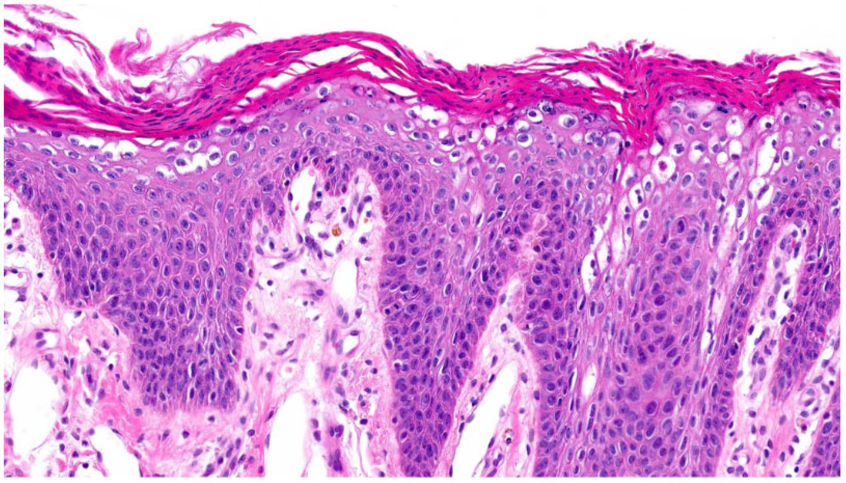 Pathological Test Pattern Defining Histological Patterns in Inherited Ichthyoses: Toward a ...