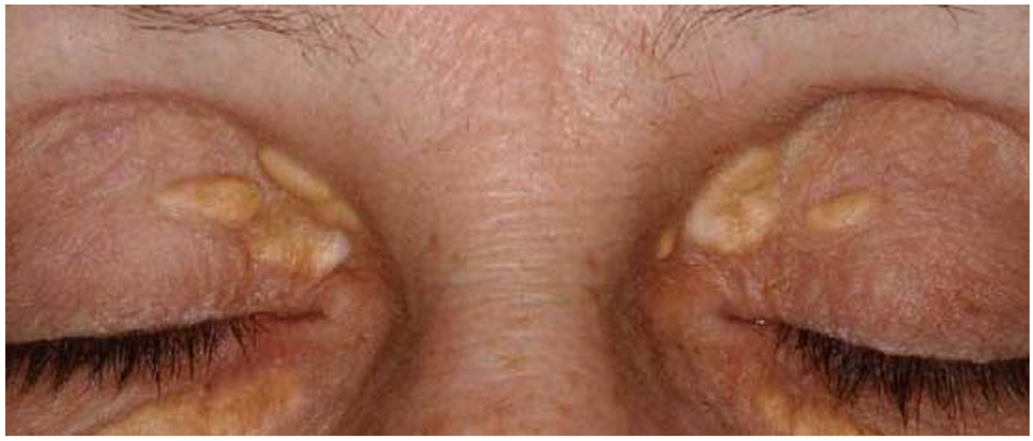 Dermatological Manifestations of Diabetes Mellitus and Its Complications