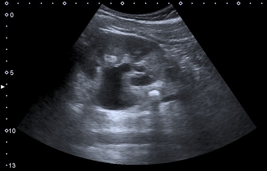glomerulonephritis ultrasound