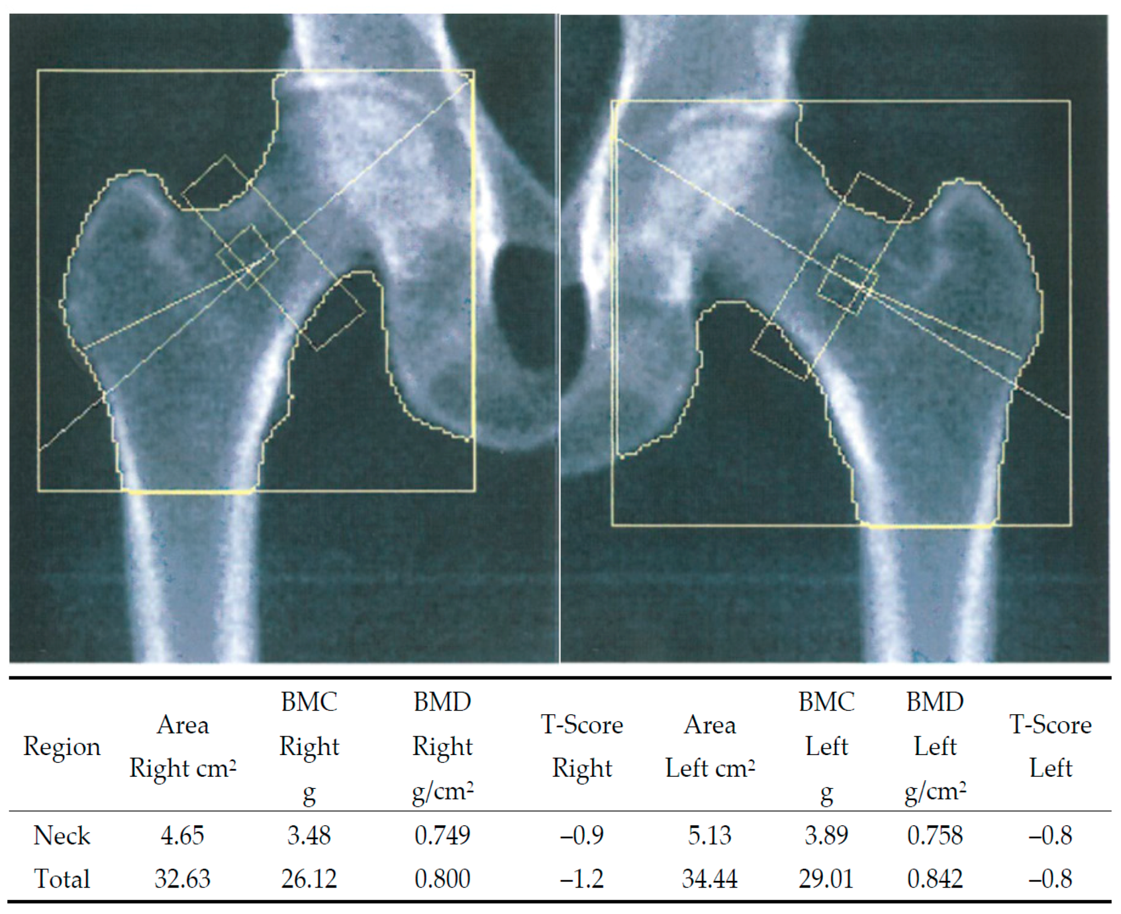 Bilateral hip DXA scan image from a 59-year-old post-menopausal woman.