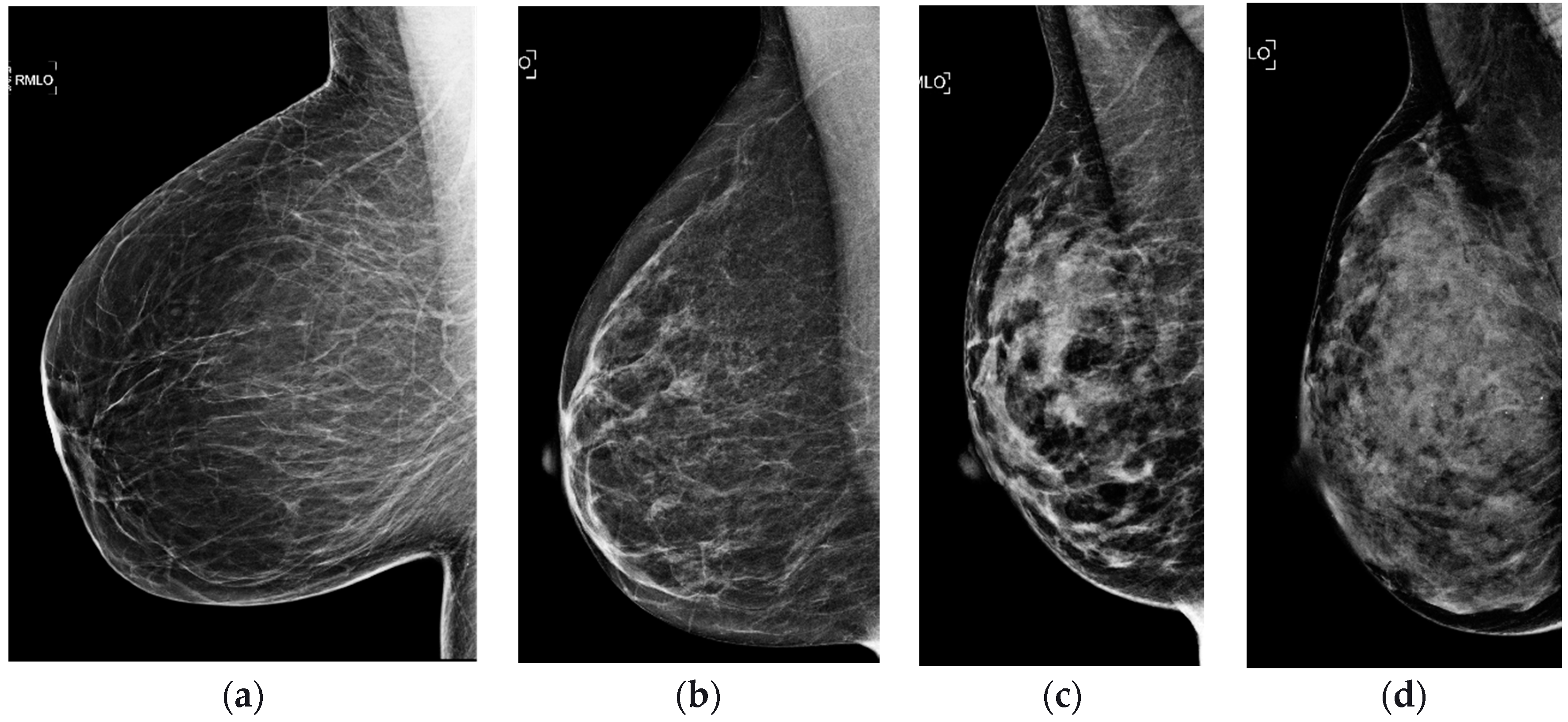 Comparison of the original breast mass images and their flipped images.