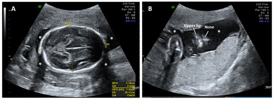 Diagnostics | Free Full-Text | Prenatal Diagnosis of Autosomal ...