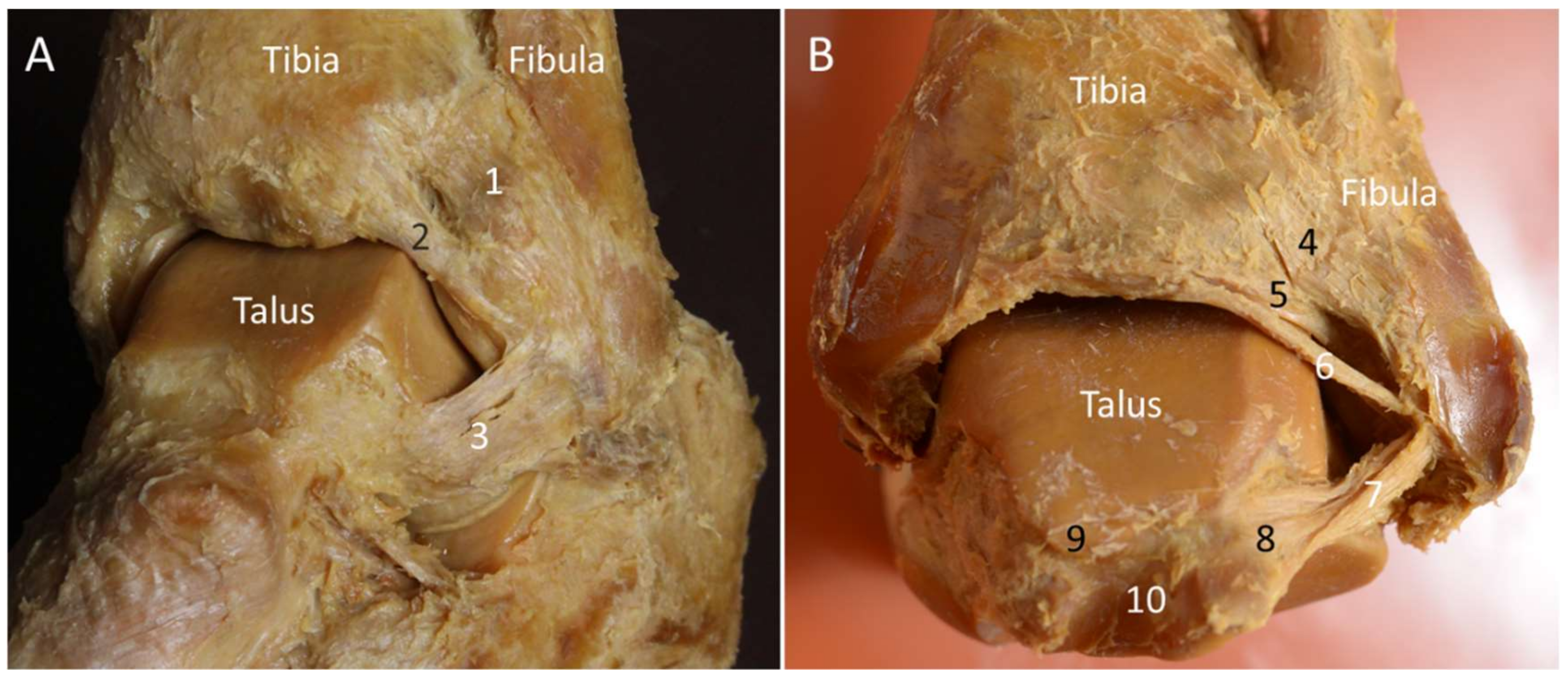 The tibiocalcaneal bundle of the deltoid ligament – Prevalence and