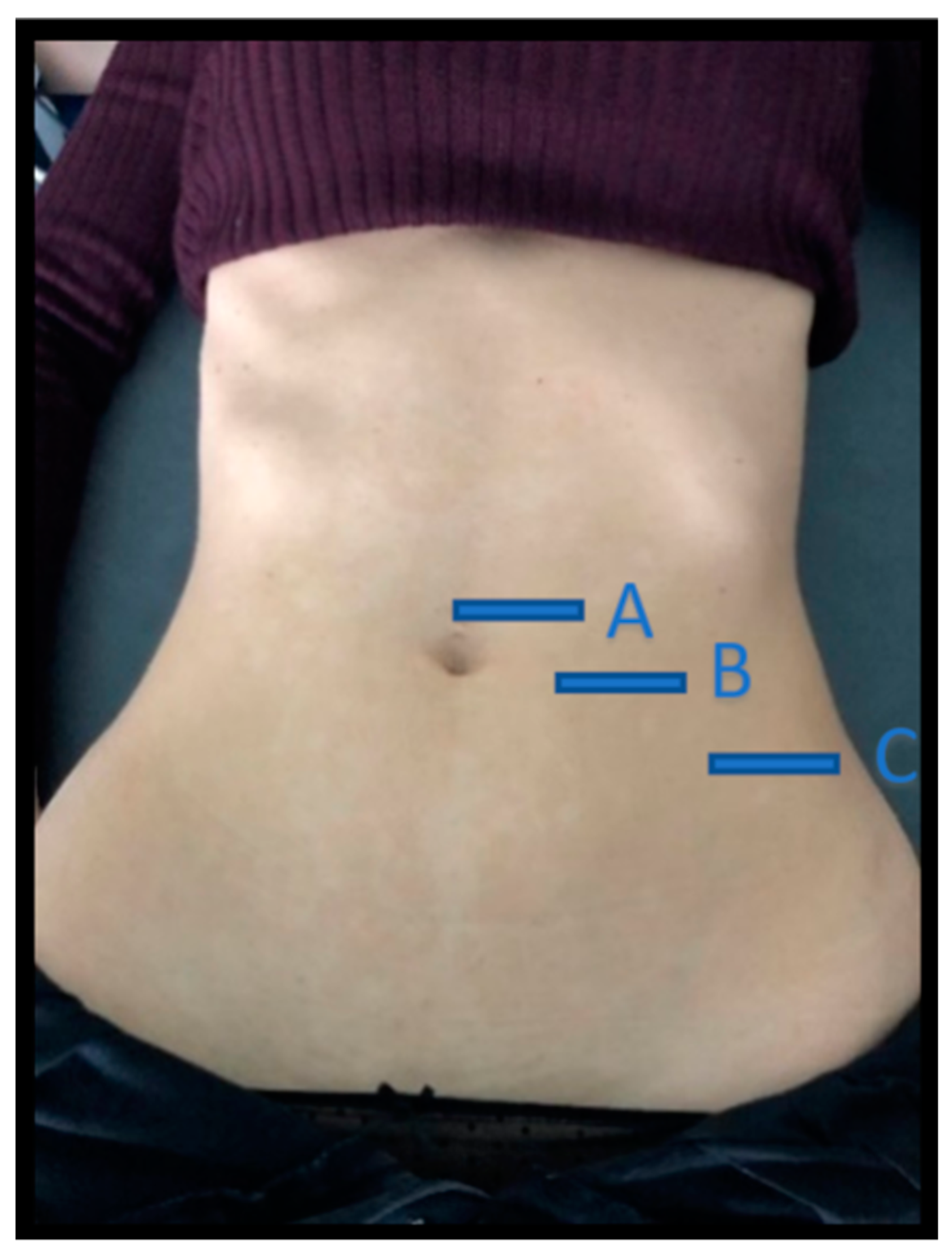 Diagnostics Free Full-Text Ultrasound Assessment of the Abdominal Wall Muscles in Women with and without Primary Dysmenorrhea A Cross-Sectional Study picture