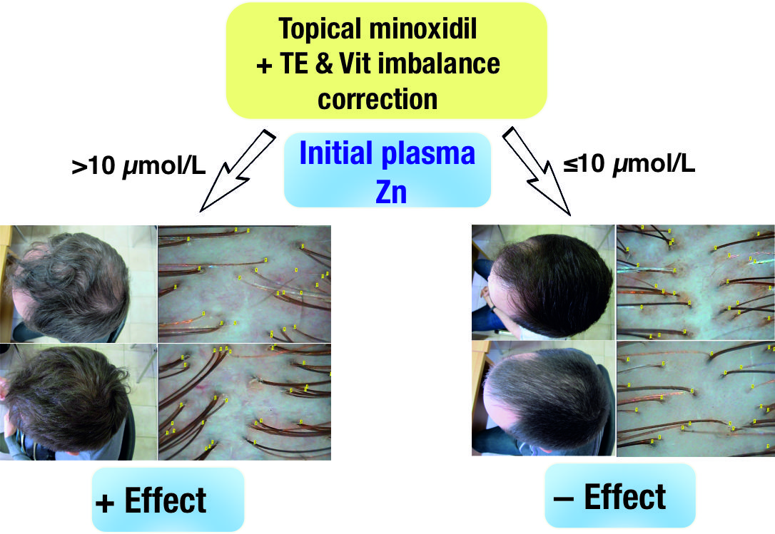 Diagnostics | Free Full-Text | Plasma Zinc Levels in Males with  Androgenetic Alopecia as Possible Predictors of the Subsequent Conservative  Therapy's Effectiveness