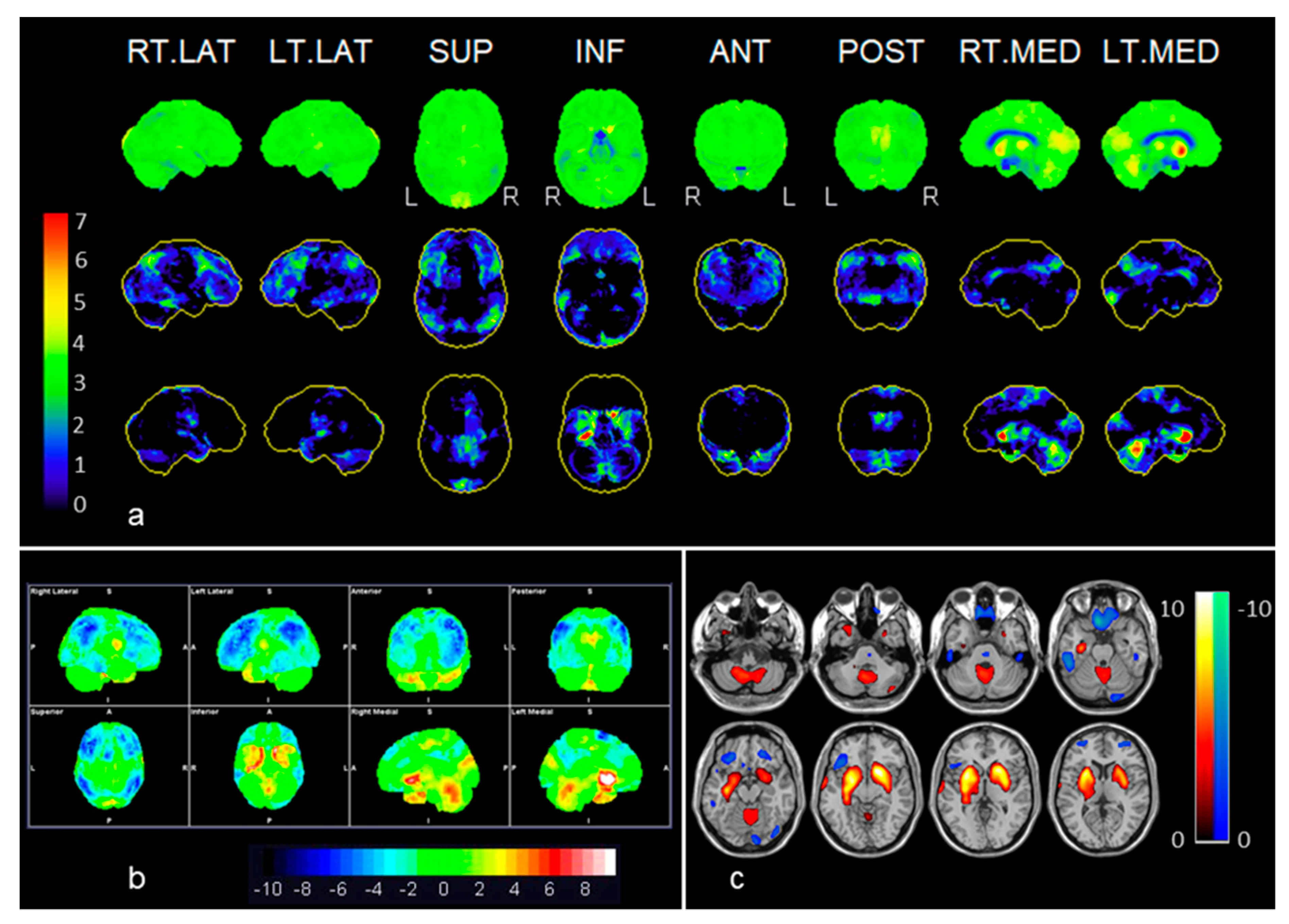 | Full-Text | 18F-FDG-PET Imaging Patterns in Autoimmune Encephalitis: Impact of Image Analysis on the Results