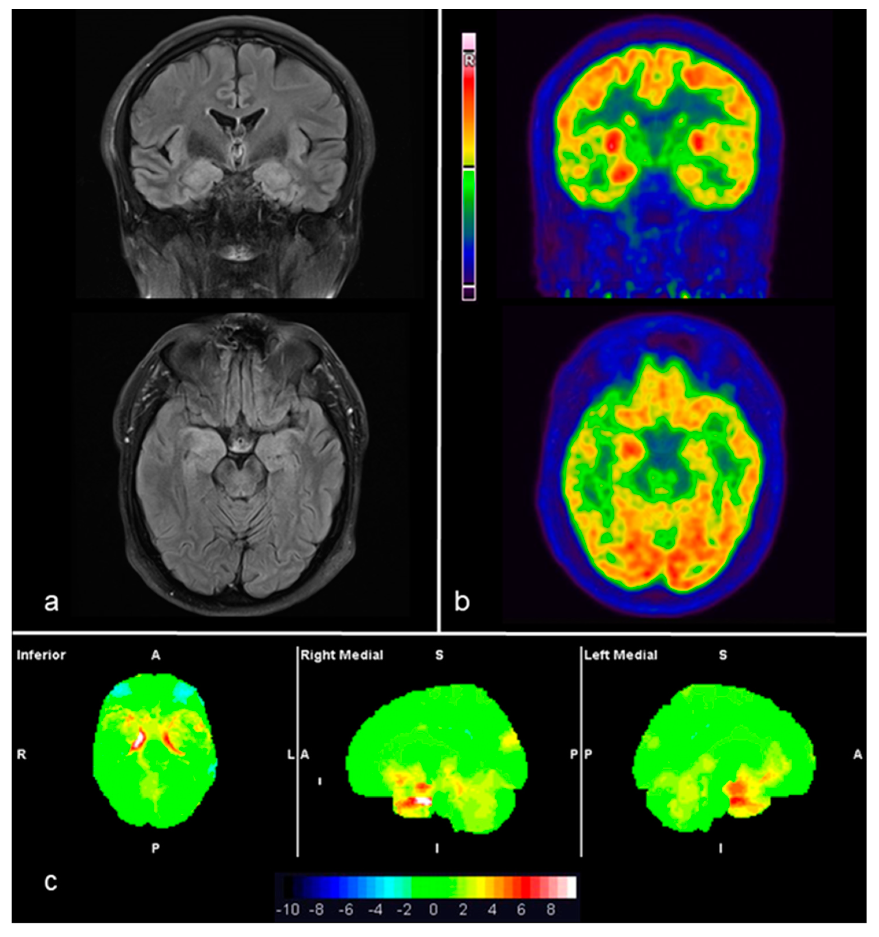 | Full-Text | 18F-FDG-PET Imaging Patterns in Autoimmune Encephalitis: Impact of Image Analysis on the Results
