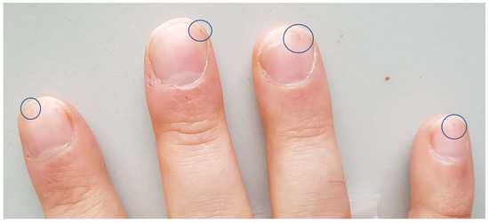 Unusual Repetitive Vasculitis Derived Splinter Hemorrhage Case in the One  Finger | Semantic Scholar
