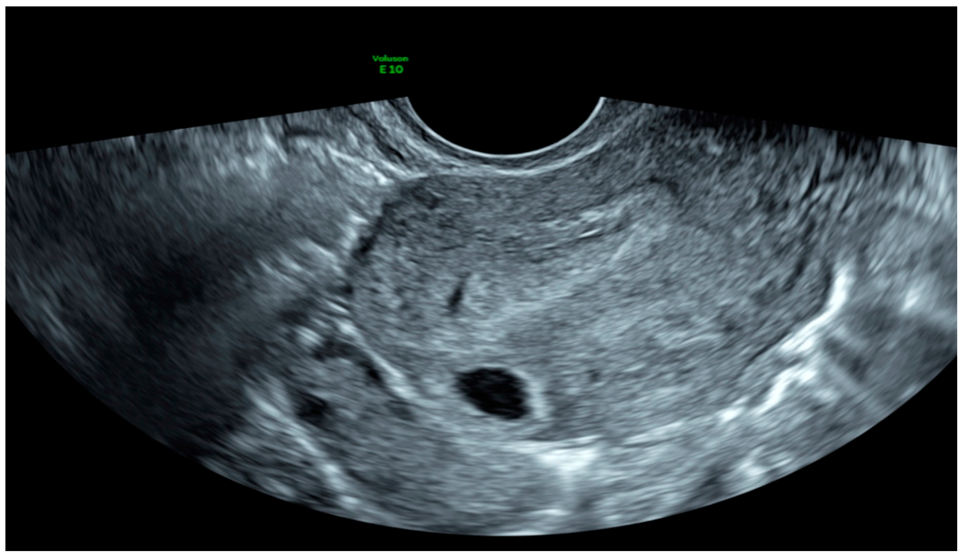 Cureus | Transvaginal Ultrasound Diagnosis of Ovarian Ectopic Pregnancy |  Article