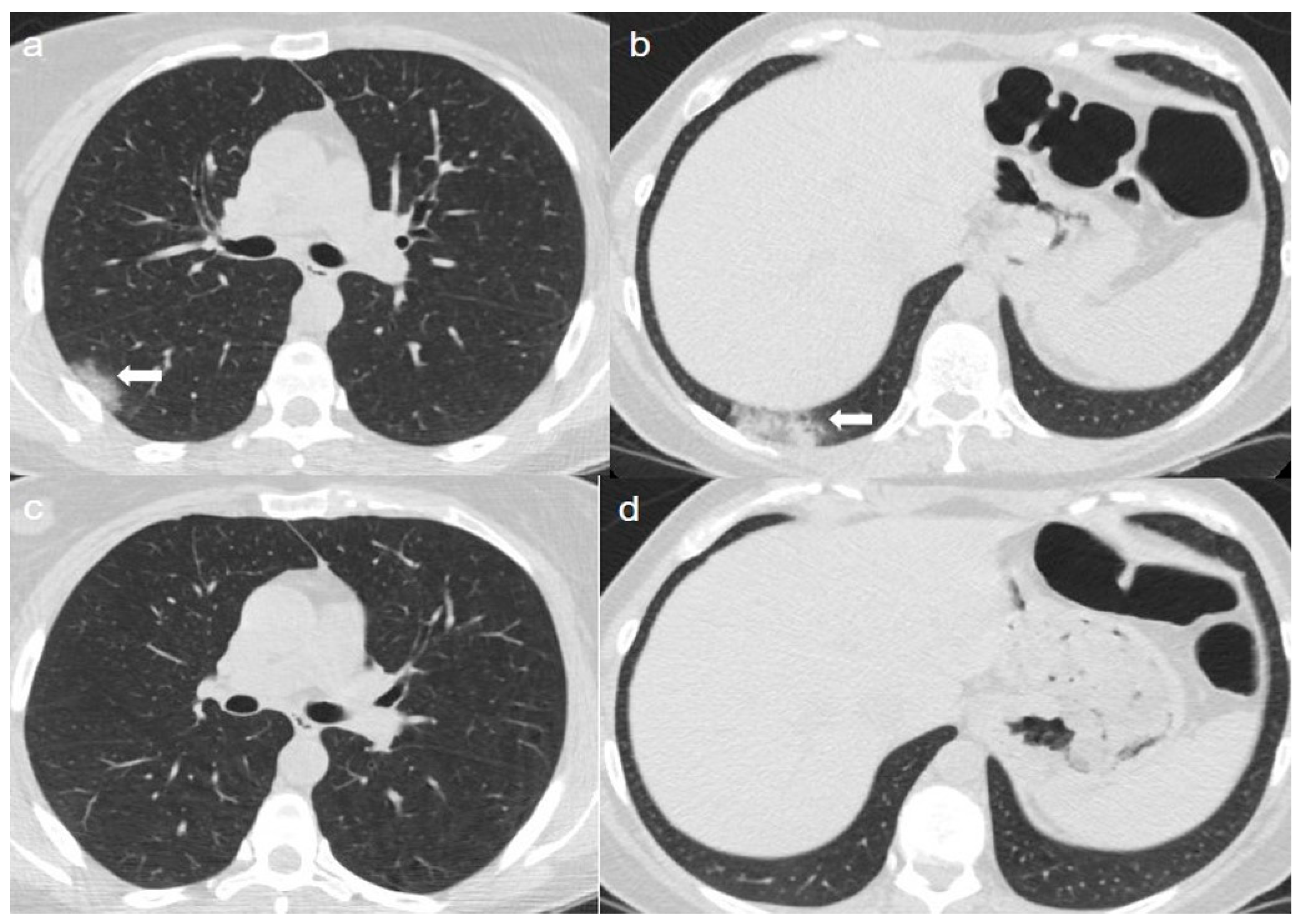 | Free Full-Text | CT Findings after Months from the Onset of COVID-19 Pneumonia: A Case