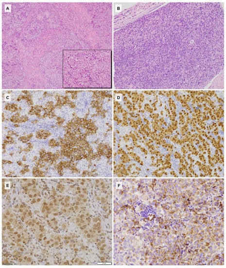 Dysgerminoma with a Somatic Exon 17 KIT Mutation and SHH Pathway ...