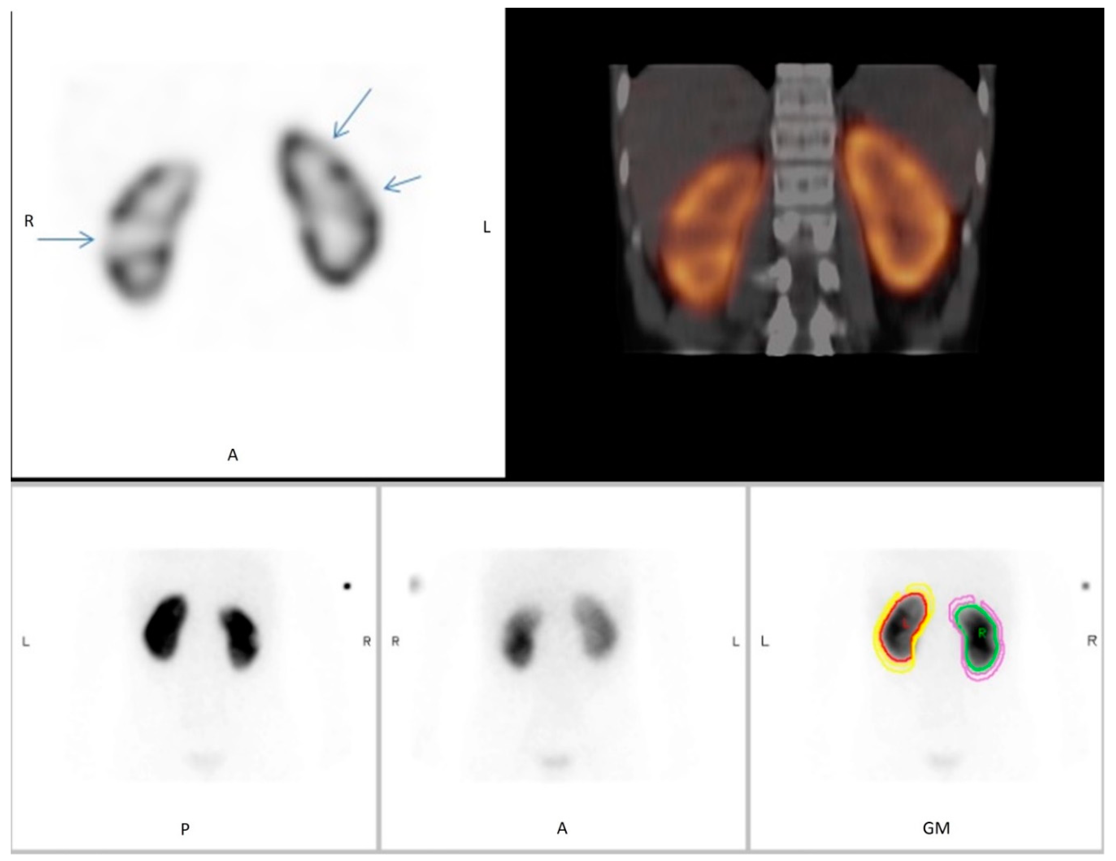 Diagnostics | Free Full-Text | Interrater Reliability of 99mTc-DMSA Scintigraphy Performed as Planar Scan vs. SPECT/Low Dose CT for Diagnosing Scarring in Children