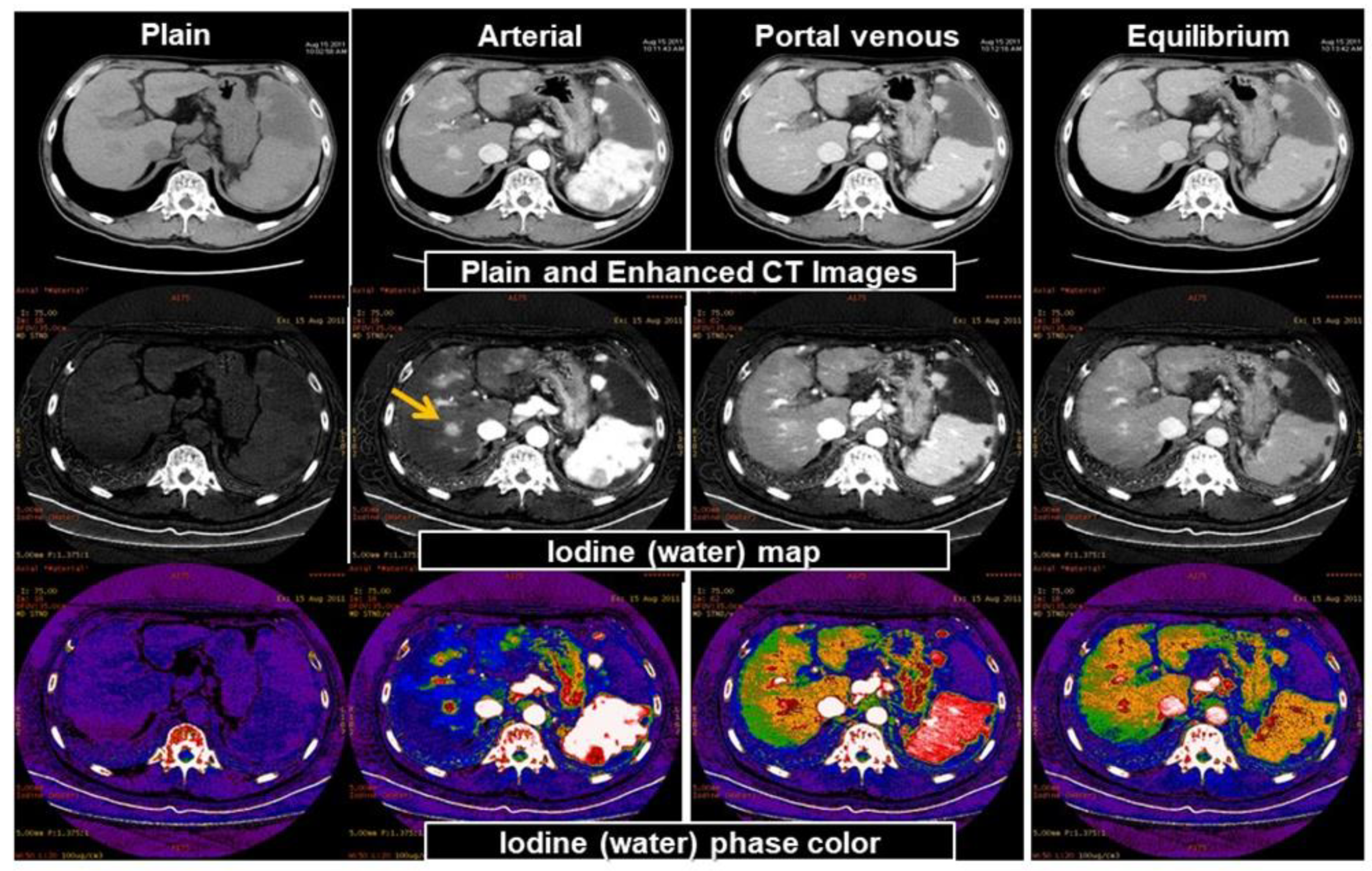 Frontiers  Dual-energy computed tomography to detect early