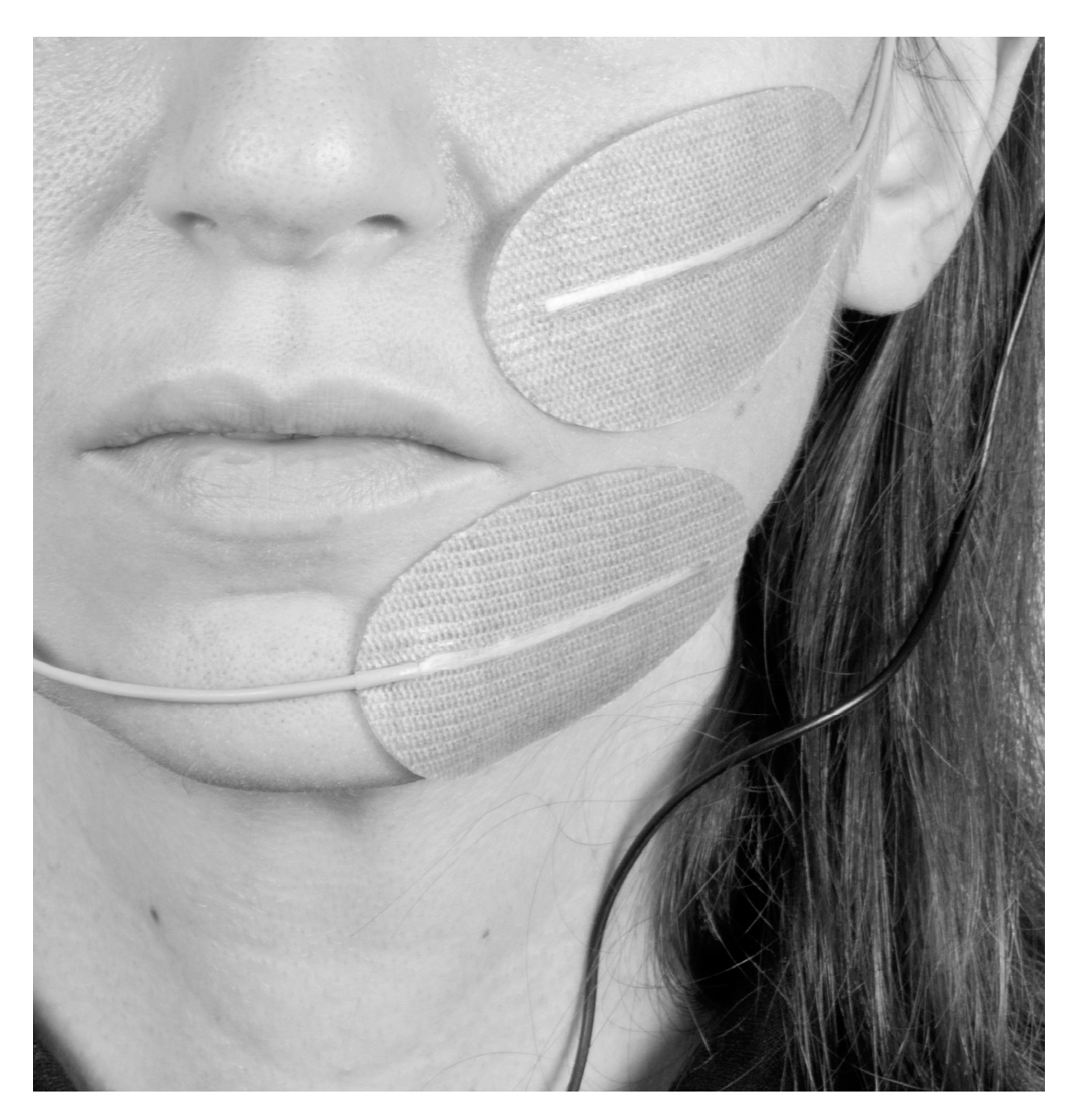 ELECTRICAL MUSCLE STIMULATION IN BELL'S PALSY
