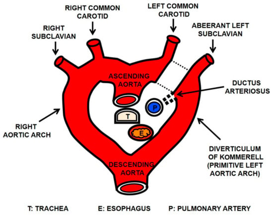 Diagnostics | Free Full-Text | Aberrant Left Subclavian Artery ...