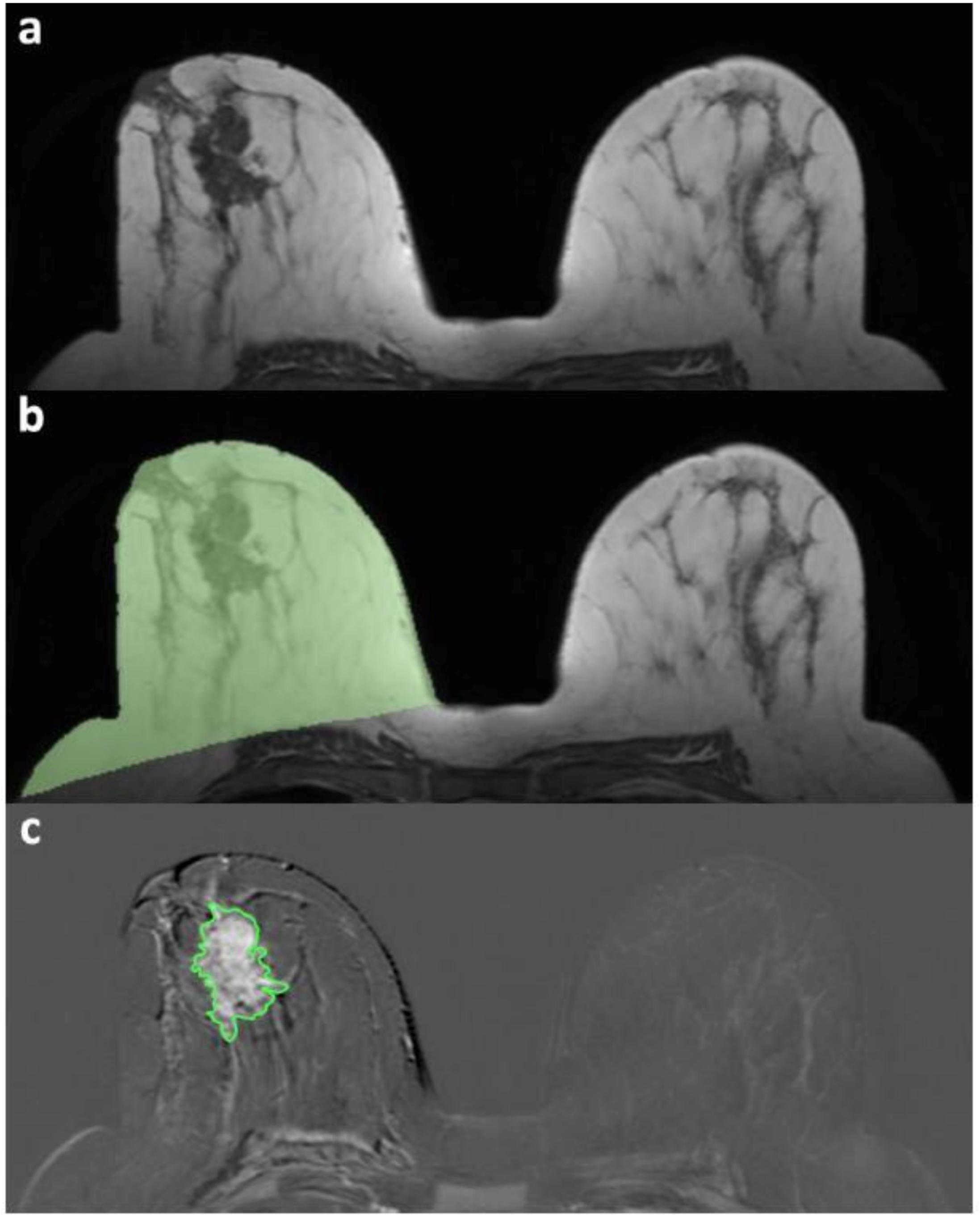 Figure 3 from Five Methods of Breast Volume Measurement: A Comparative  Study of Measurements of Specimen Volume in 30 Mastectomy Cases