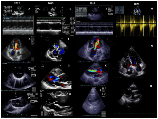 Diagnostics | Free Full-Text | Major Aortic Reconstruction with the ...