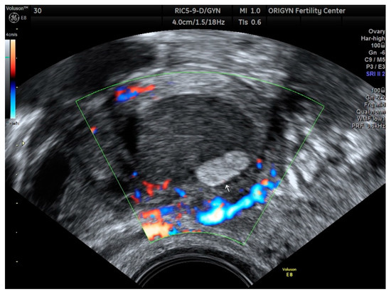 Ultrasound Leadership Academy: Ultrasound in Early Pregnancy — EM Curious