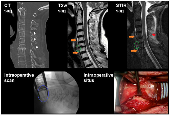 Occult Disco-Ligamentous Lesions of the Subaxial c-Spine—A Comparison ...