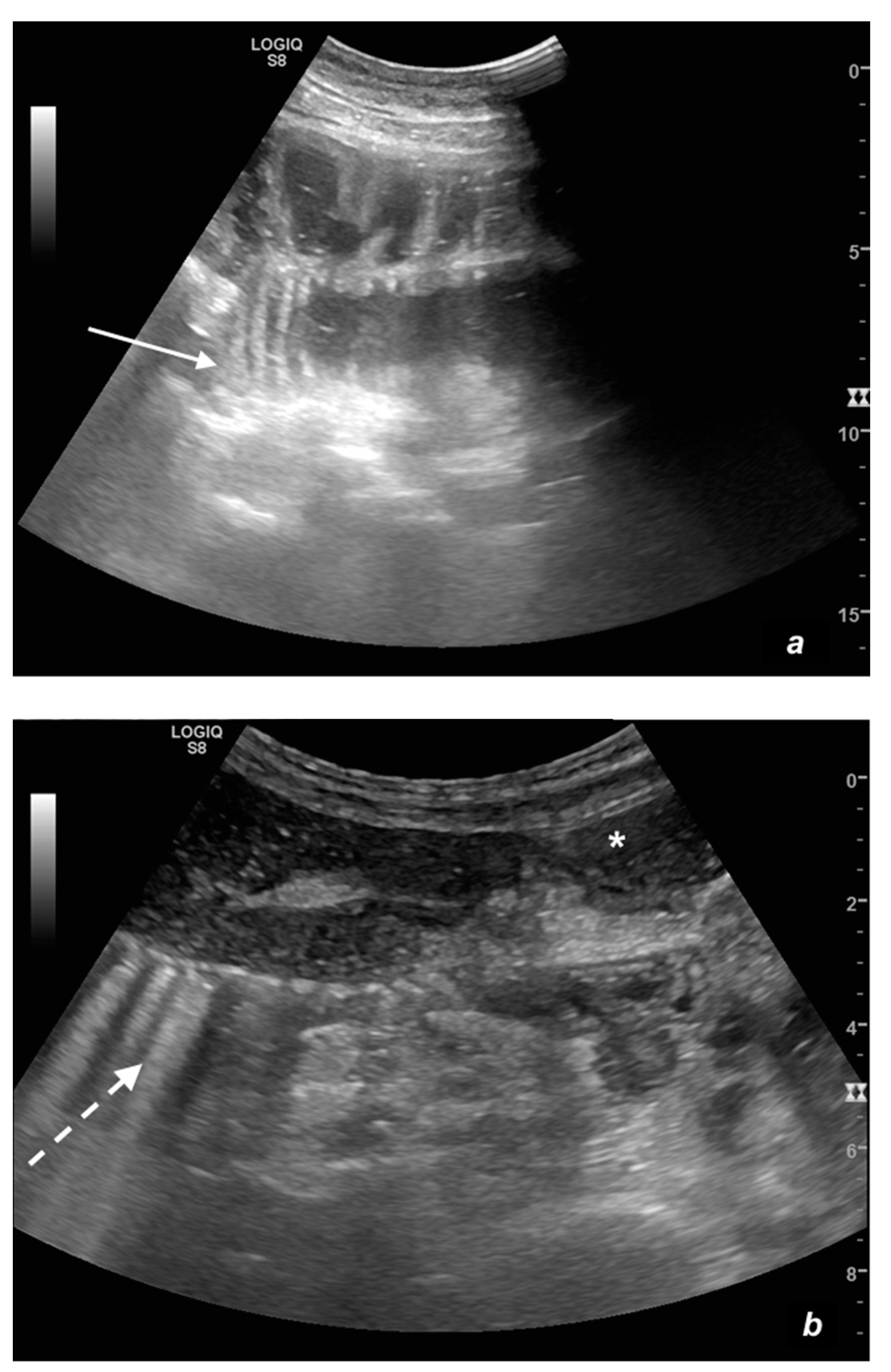 Diagnostics Free Full Text Ultrasound Of Small Bowel Obstruction A