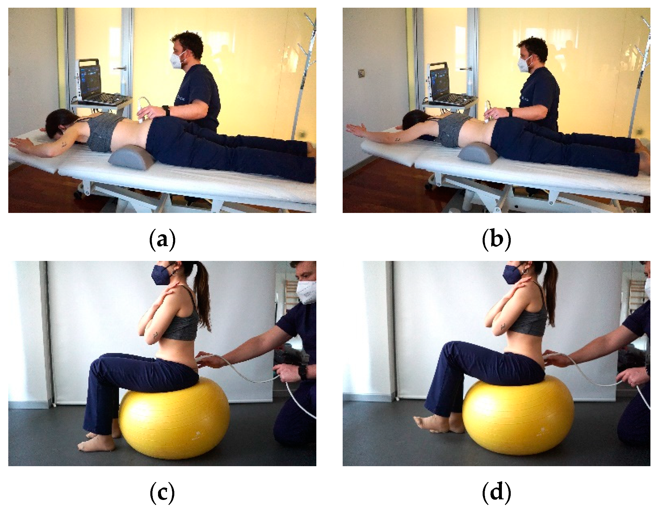 Combined neuromuscular electrical stimulation with motor control exercise  can improve lumbar multifidus activation in individuals with recurrent low back  pain