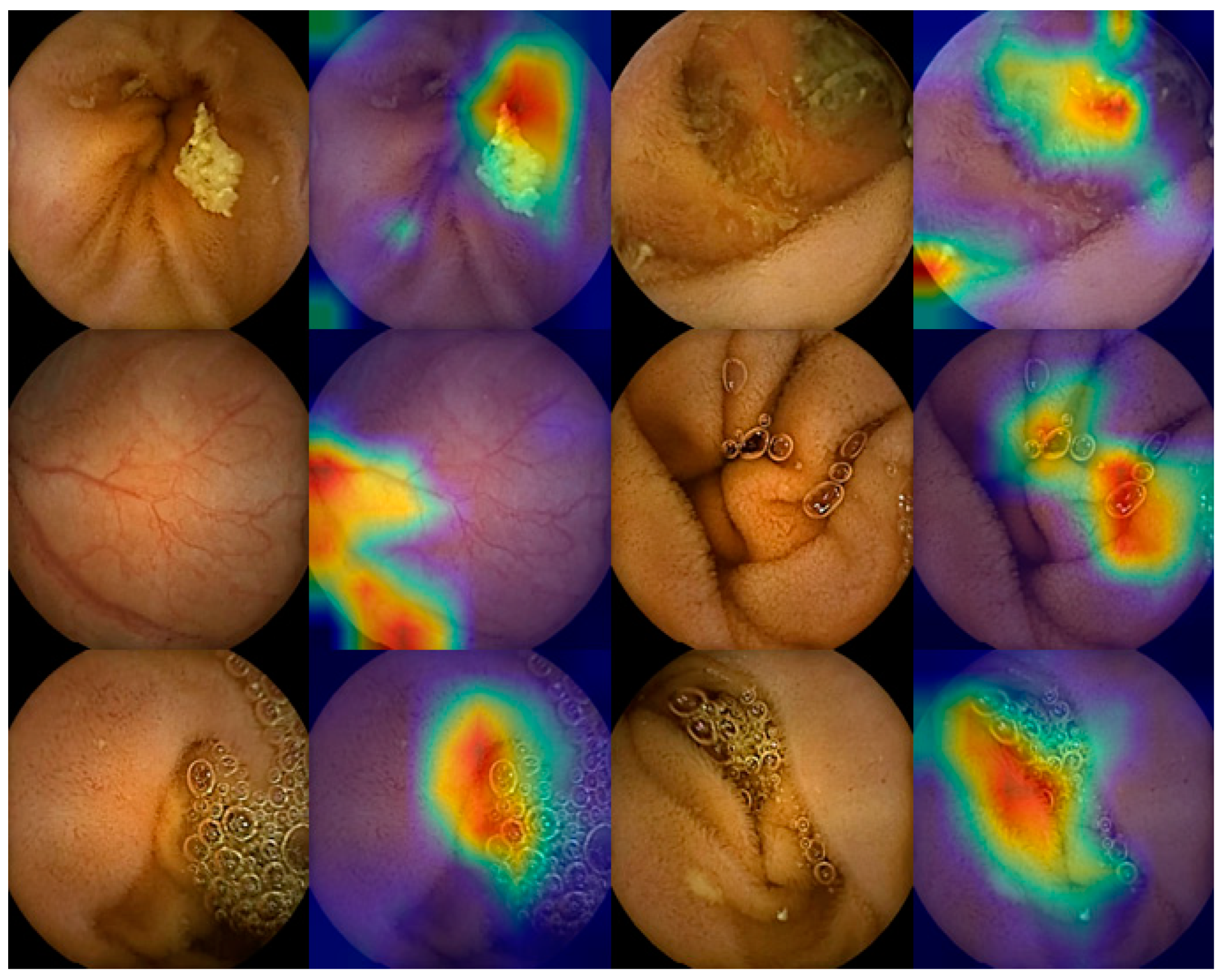 ID: 3526558 ARTIFICIAL INTELLIGENCE AND COLON CAPSULE ENDOSCOPY: AUTOMATIC  DETECTION OF COLONIC PROTUBERANT LESIONS USING A CONVOLUTIONAL NEURAL  NETWORK - Gastrointestinal Endoscopy