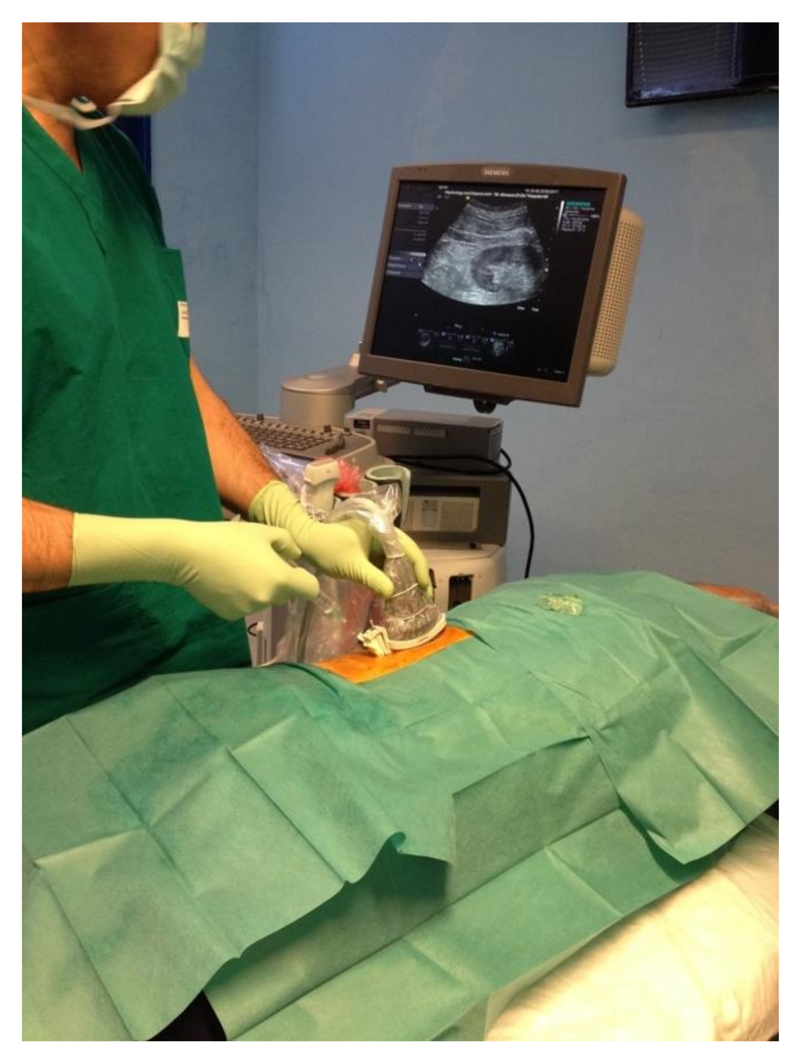 kidney cyst ultrasound and biopsy procedure