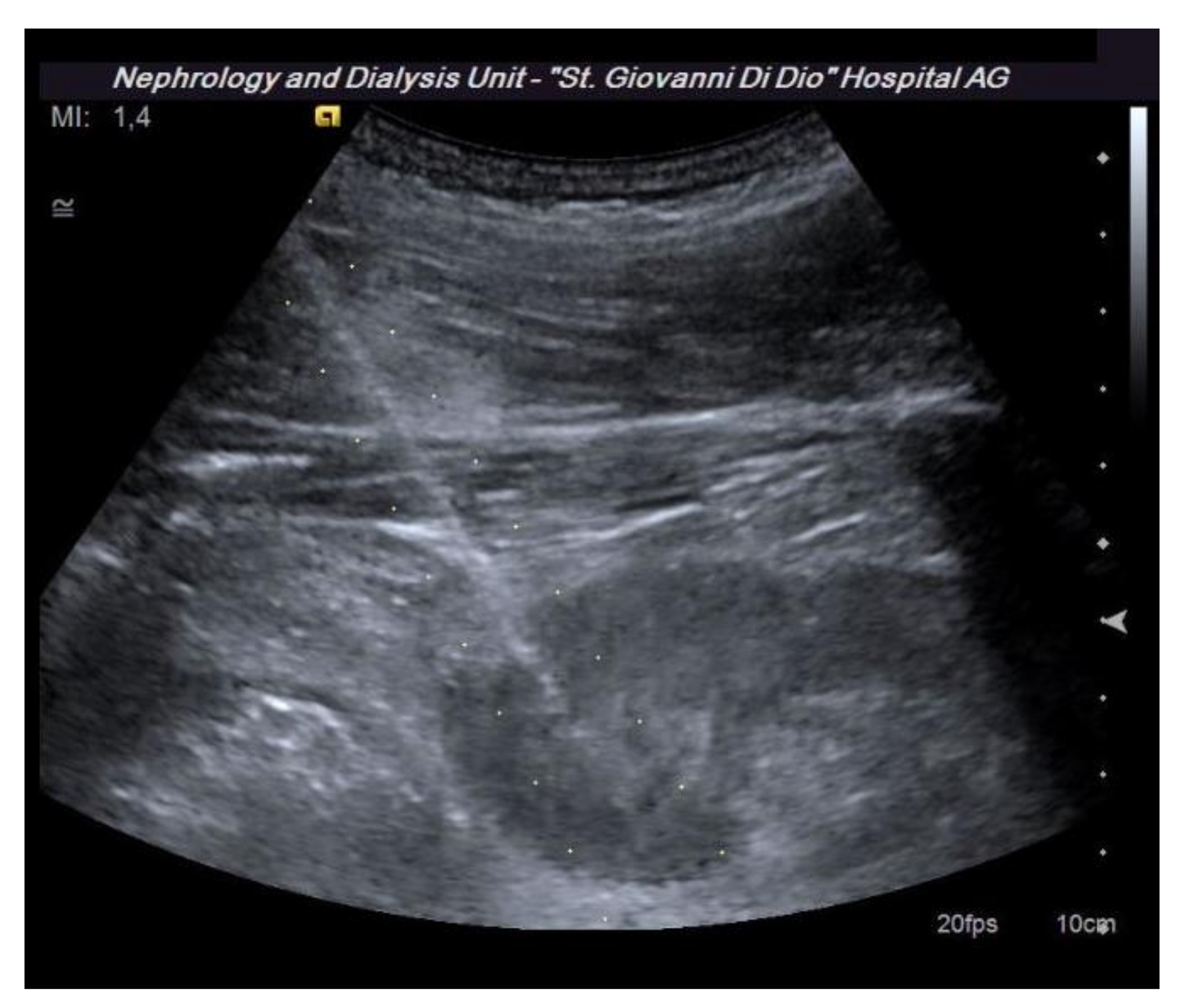 kidney cyst ultrasound and biopsy procedure