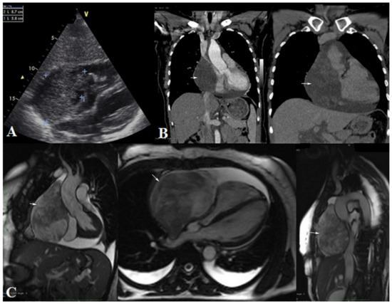 Diagnostics | Free Full-Text | Primary Pericardial Synovial Sarcoma: A ...