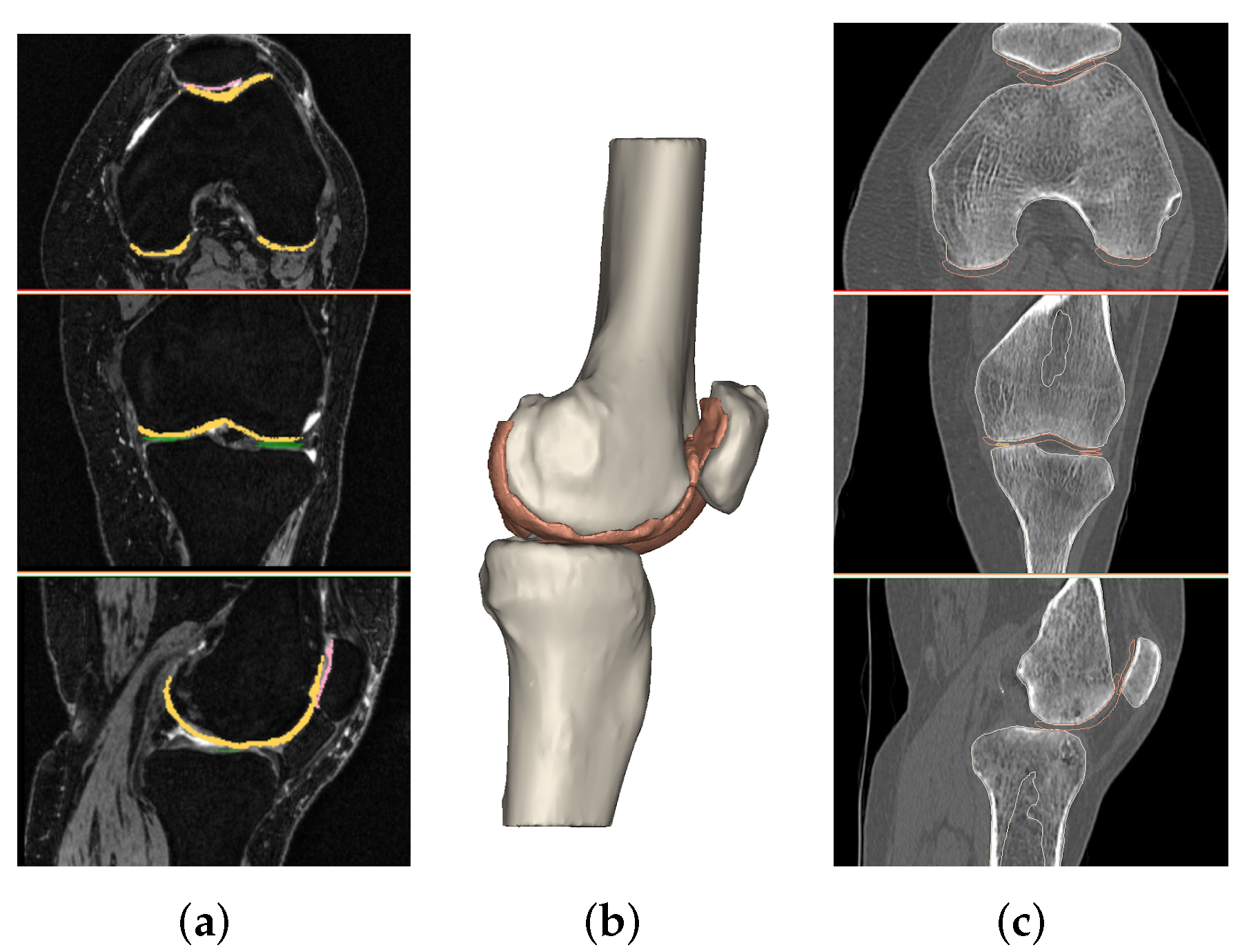 Diagnostics | Free Full-Text | CT- and MRI-Based 3D Reconstruction of Knee  Joint to Assess Cartilage and Bone