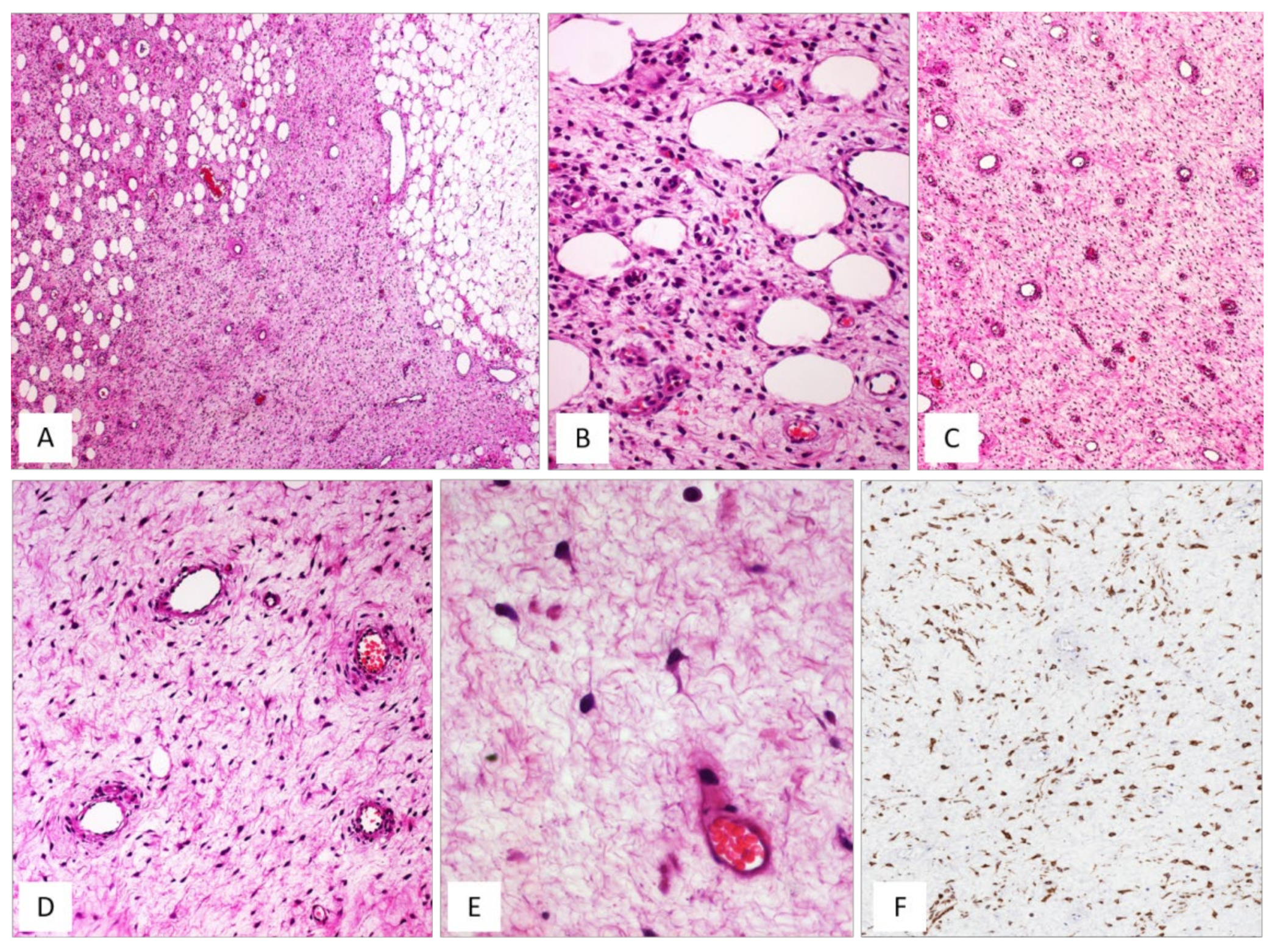 Spindle cell lipoma. (A) A fatty-tumor with interspersed fibro-myxoid