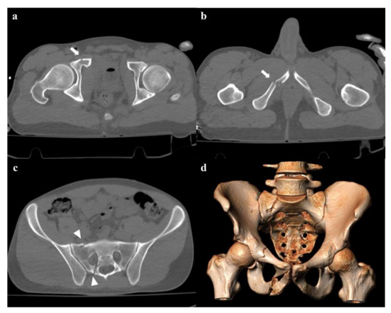 Traumatic Diaphragmatic Hernia Associated with Pelvic Ring Fracture |  Chinese Medical Journal