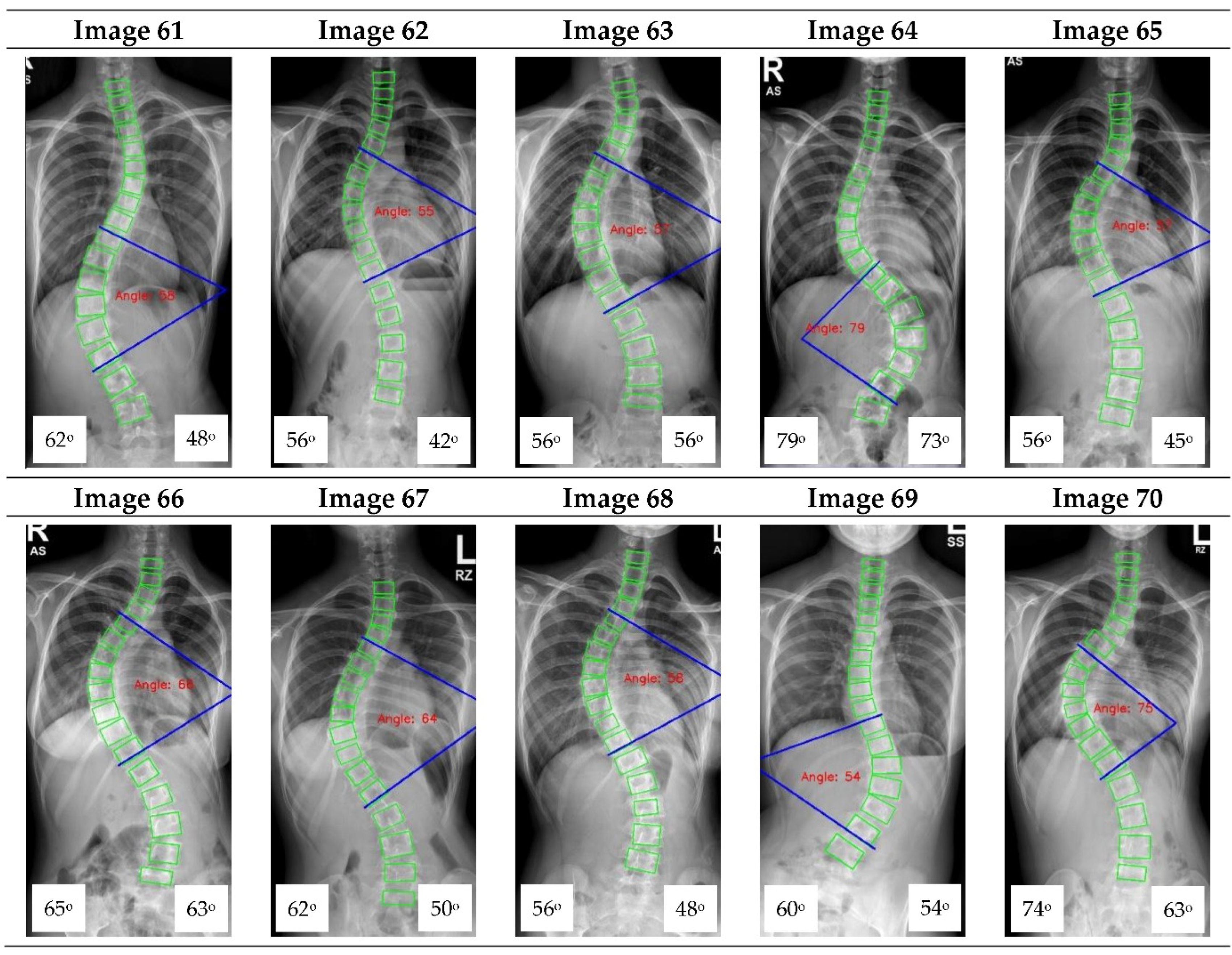 Cobb's angle (*) measurement in scoliosis. (A) Before application of