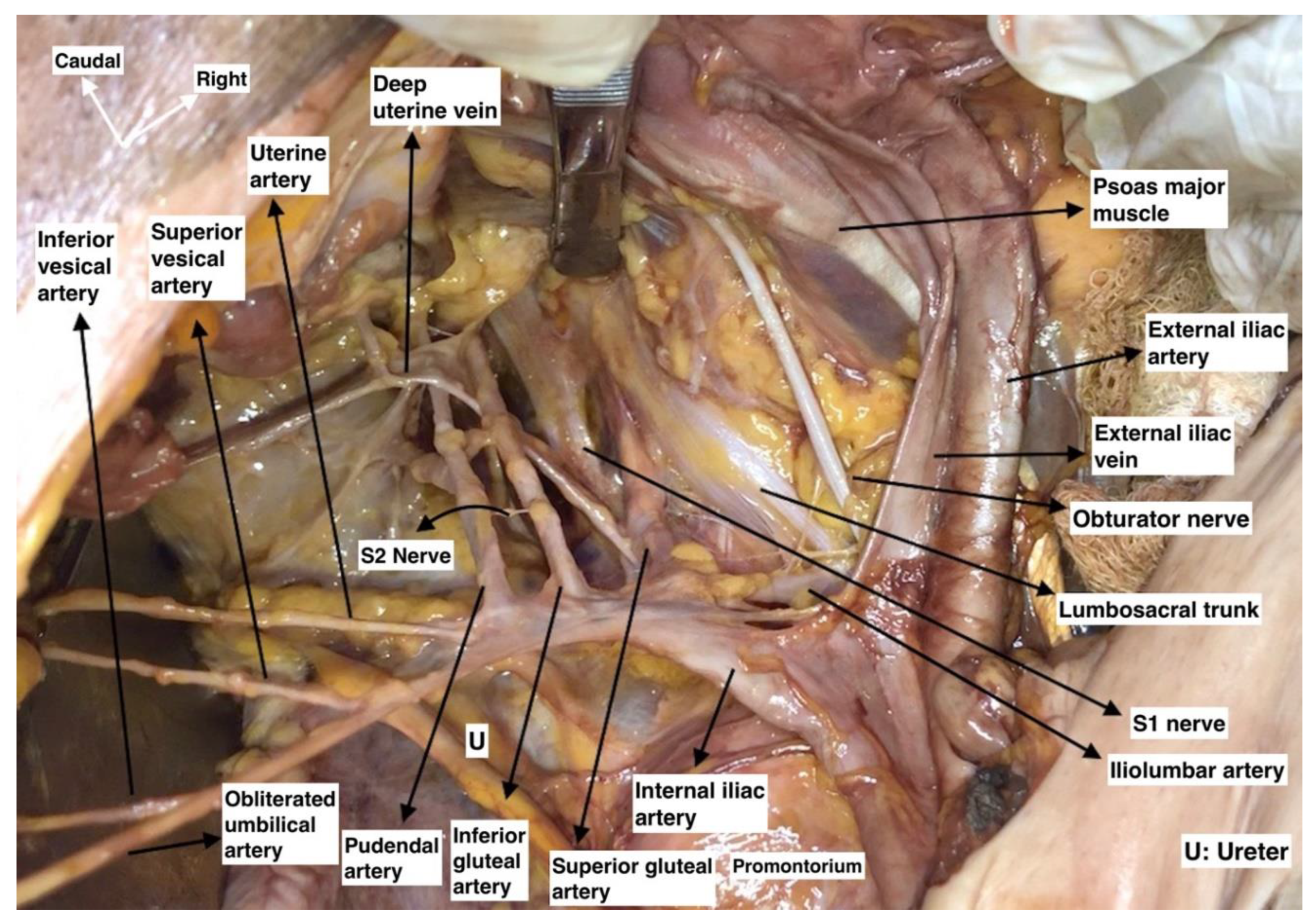 common iliac artery cadaver