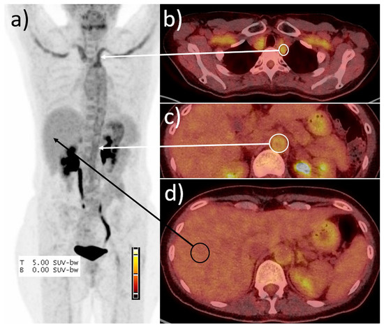A Simplified PET/CT Measurement Routine with Excellent Diagnostic ...