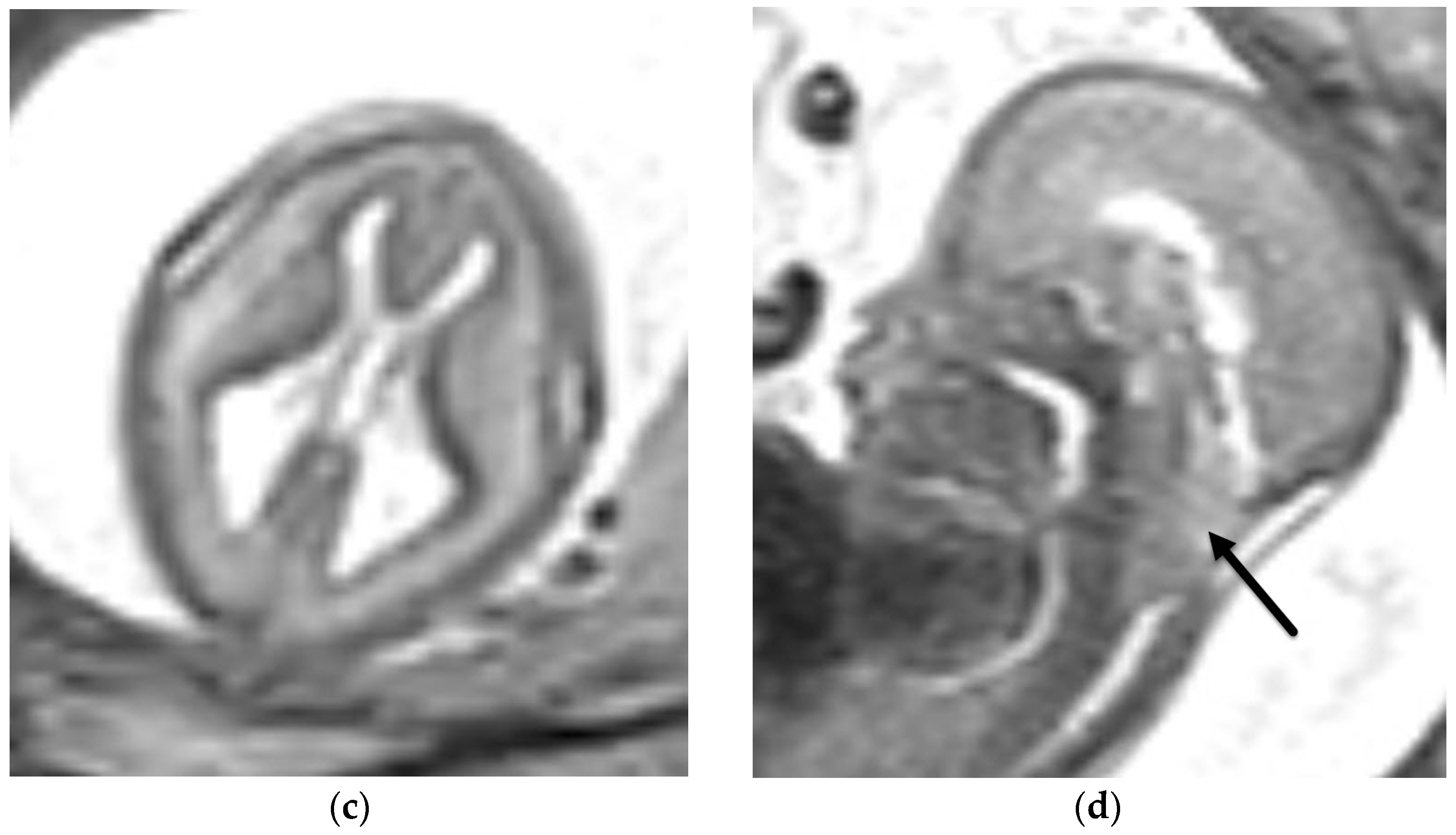 Banana sign (cerebellum)  Radiology Reference Article