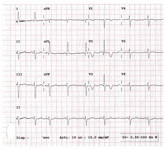 Diagnostics | Free Full-Text | Wellens’ Syndrome from COVID-19 ...