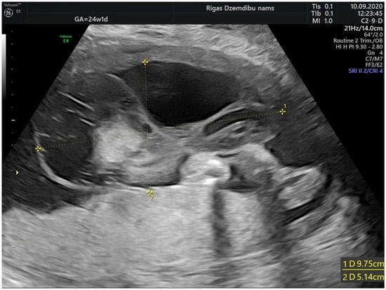 Diagnostics | Free Full-Text | Large Angiomyxoma of the Umbilical Cord