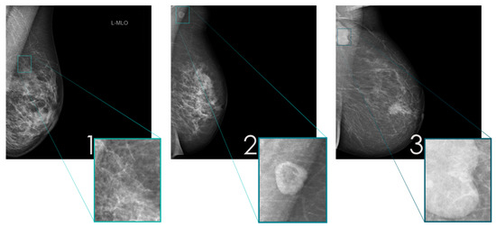 Diagnostics | Free Full-Text | Detecting Abnormal Axillary Lymph Nodes ...