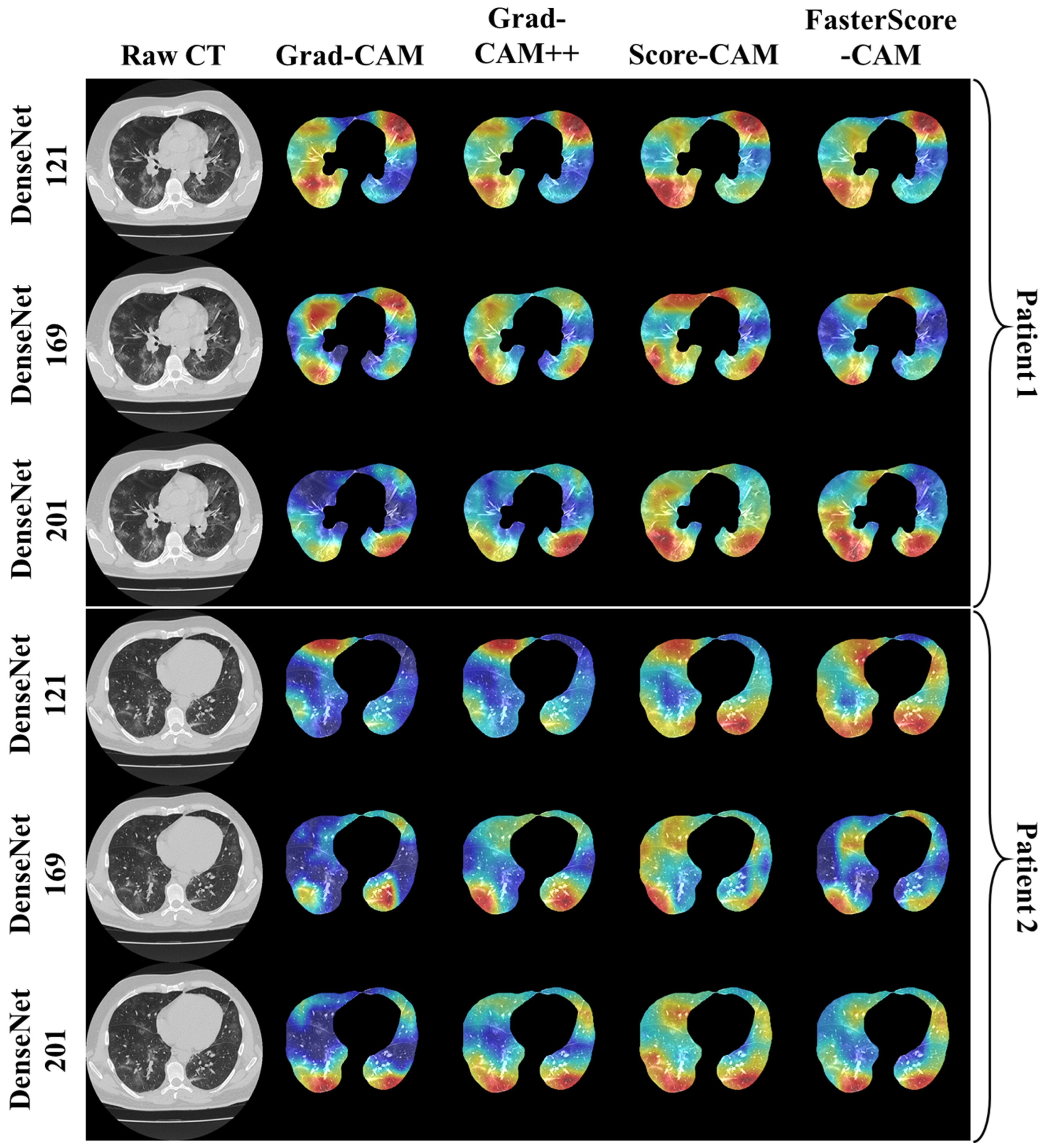 Diagnostics | Free Full-Text | Explainable Computed Lesion Learning Tomography Deep COVID-19 in Cloud-Based for Localization System Scans 2.0-cXAI: COVLIAS